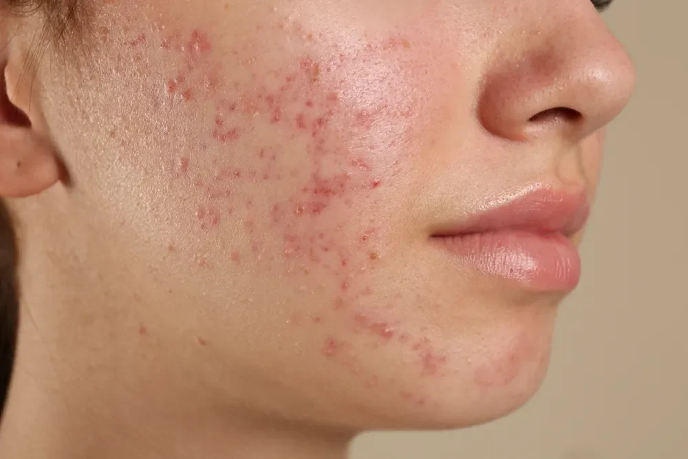 A girl suffering from acne on her cheek and chin region