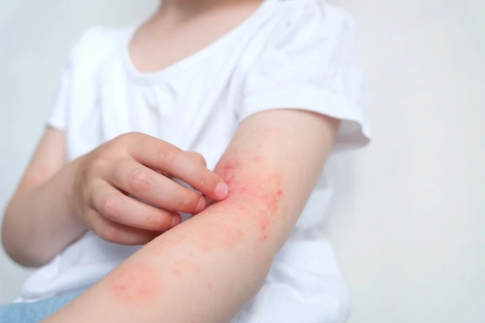 A woman suffering from chronic dermatitis on her arm