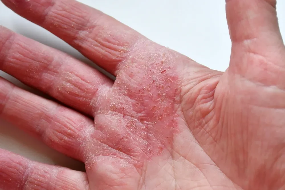 The skin on the palm reddened and cracked due to eczema