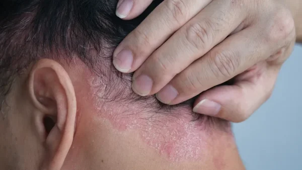 A man suffering from psoriasis on the nape