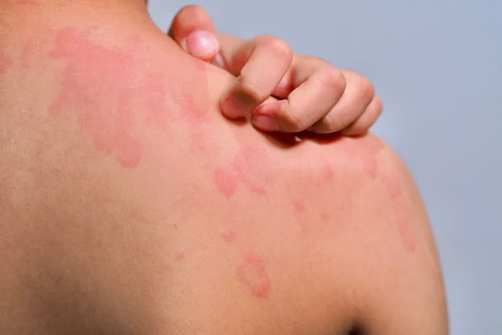 A person suffering from urticaria or hives on the shoulder region
