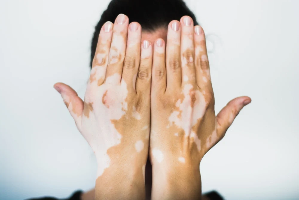 A man covering his face with his hands who is suffering from vitiligo