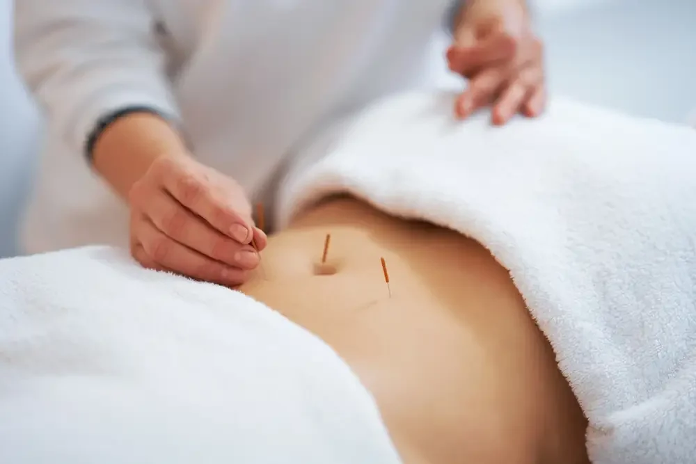 A therapist is doing acupuncture on a patient’s stomach to treat irregular cycles