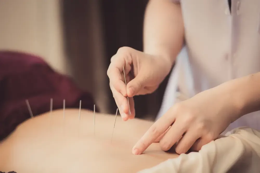A therapist is doing acupuncture on the back of a female patient for fertility treatment